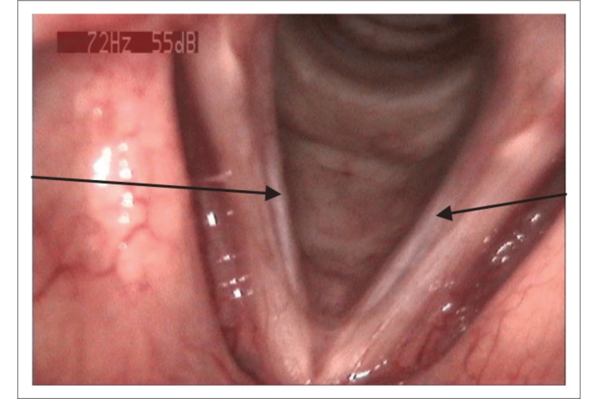 sulcus vocalis