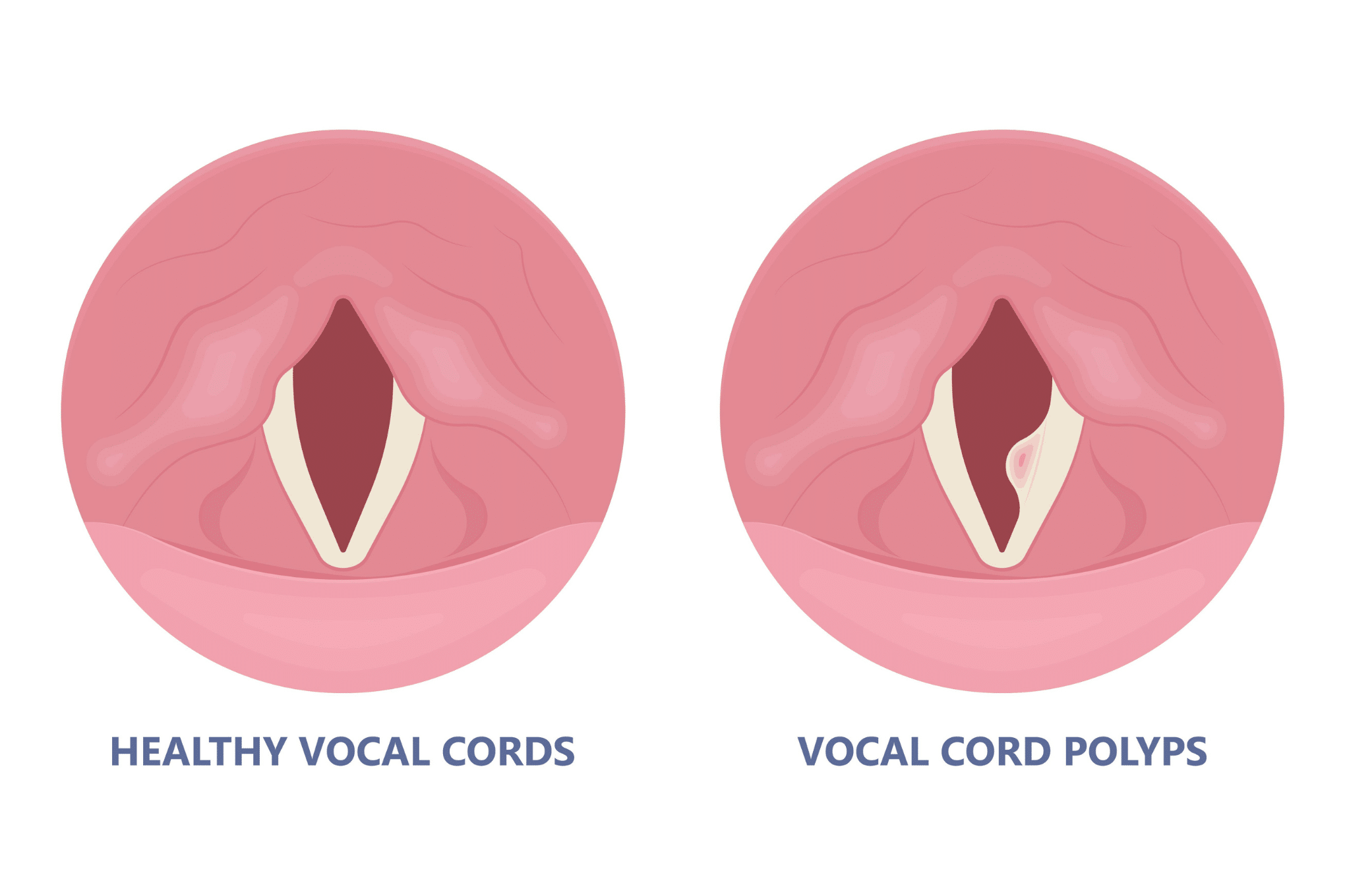 vocal polyps